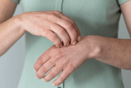 Eczema-Image