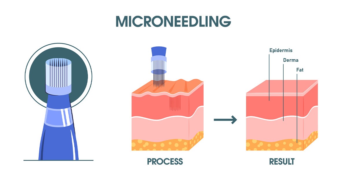 Microneedling Flow
