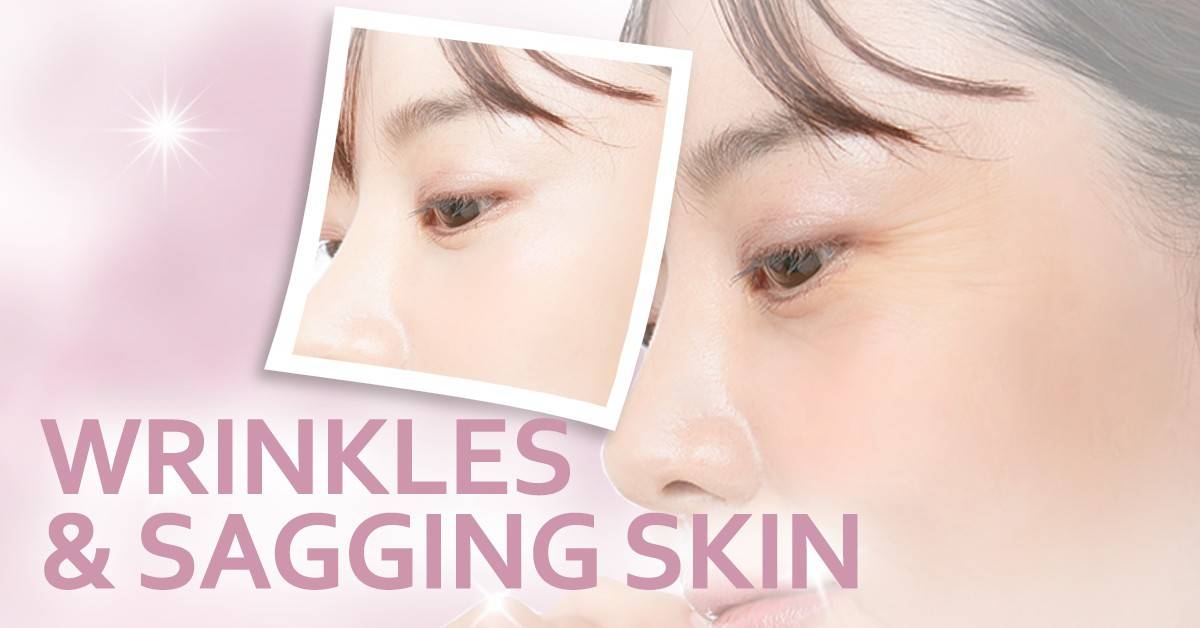Wrinkles & Sagging Skin