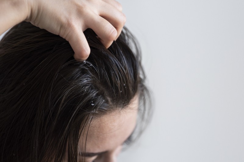 Hair & Scalp Problem - A Klinik