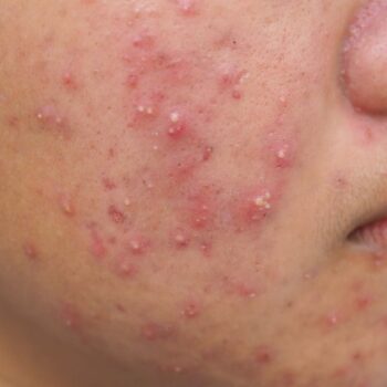 acne (1)