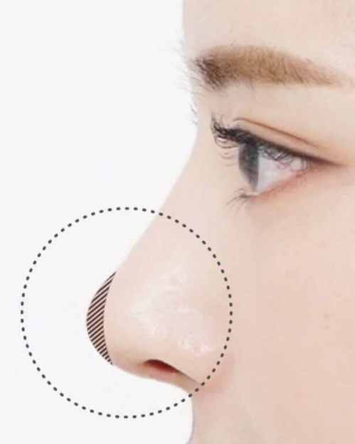 nose tip projection