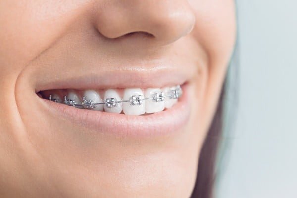 braces penang