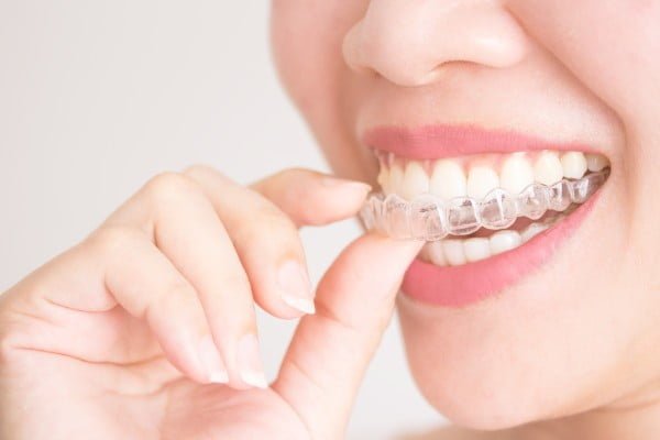 clear aligners penang