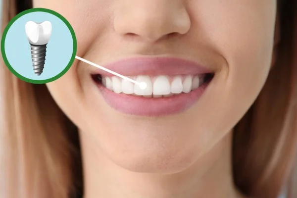 dental implants penang