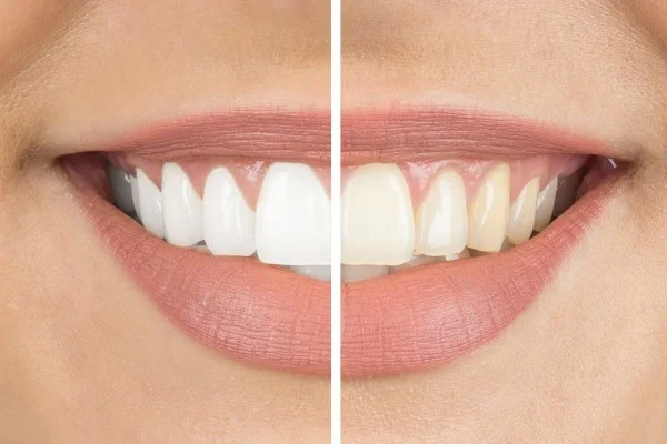 teeth whitening penang