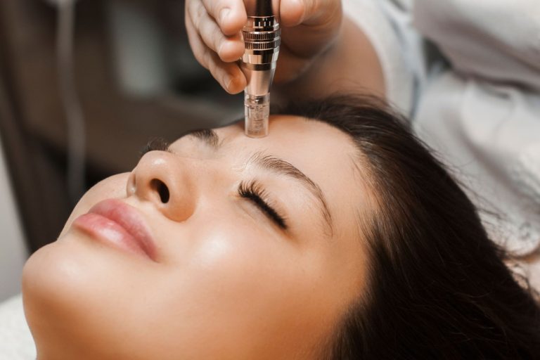 microneedling