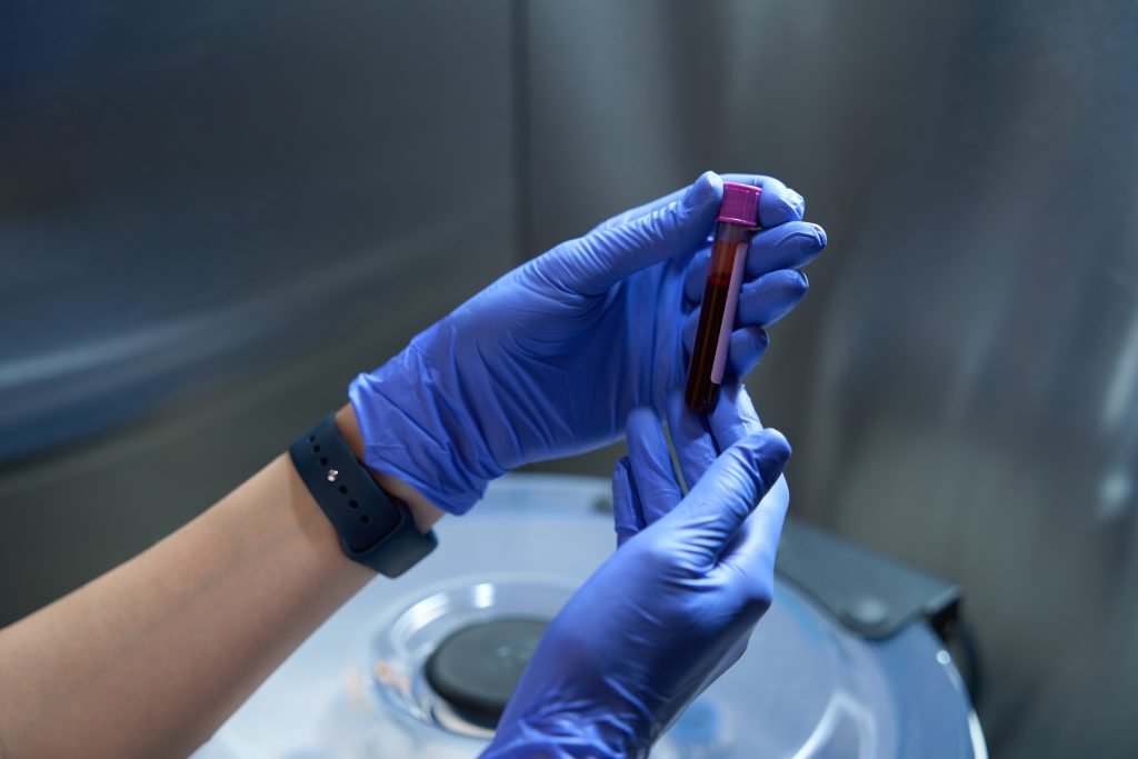 Cropped photo of health worker in latex gloves is holding a test tube with prp blood in it