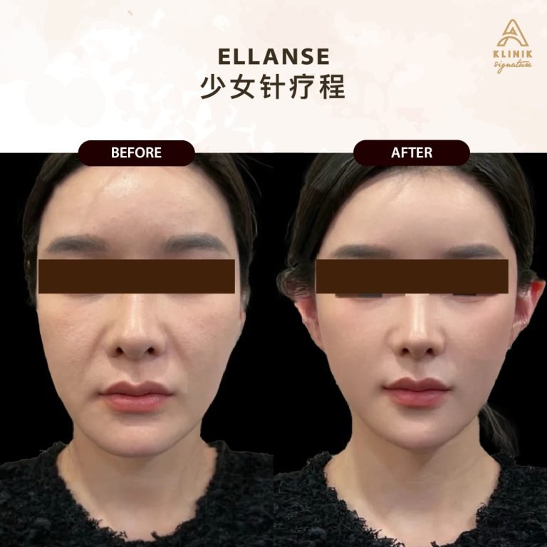 Copy of ELLANSE (1)
