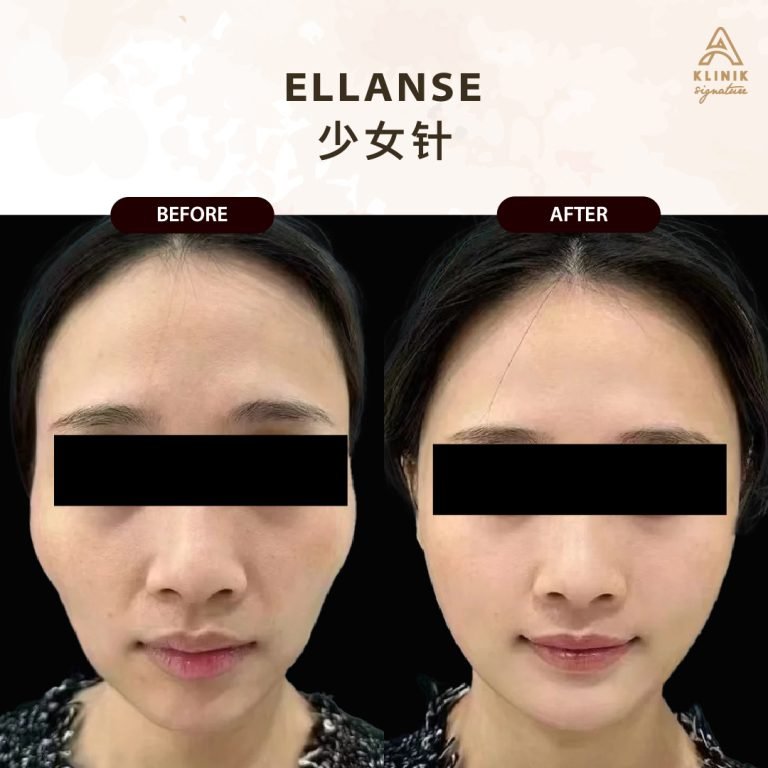 Copy of ELLANSE (2)(1)