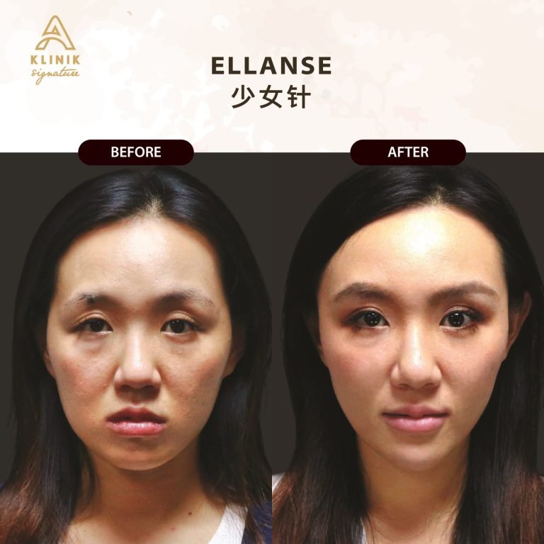 Copy of ELLANSE (3)