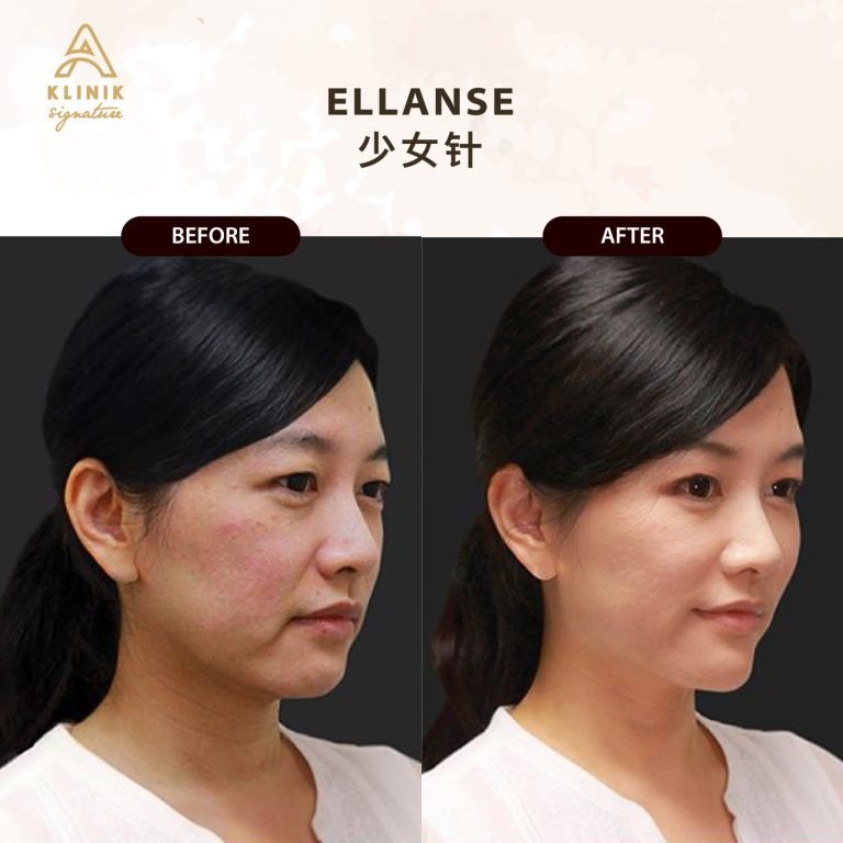 Copy of ELLANSE (4)