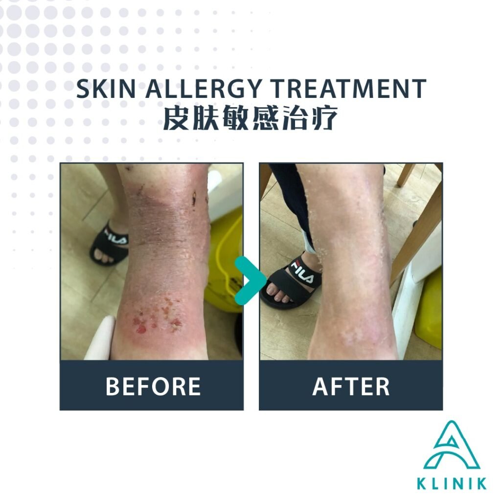 Before and after skin allergy treatment at A Klinik Puchong – visible improvement
