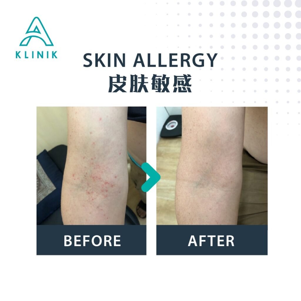 Before and after skin allergy treatment at A Klinik Puchong – visible improvement