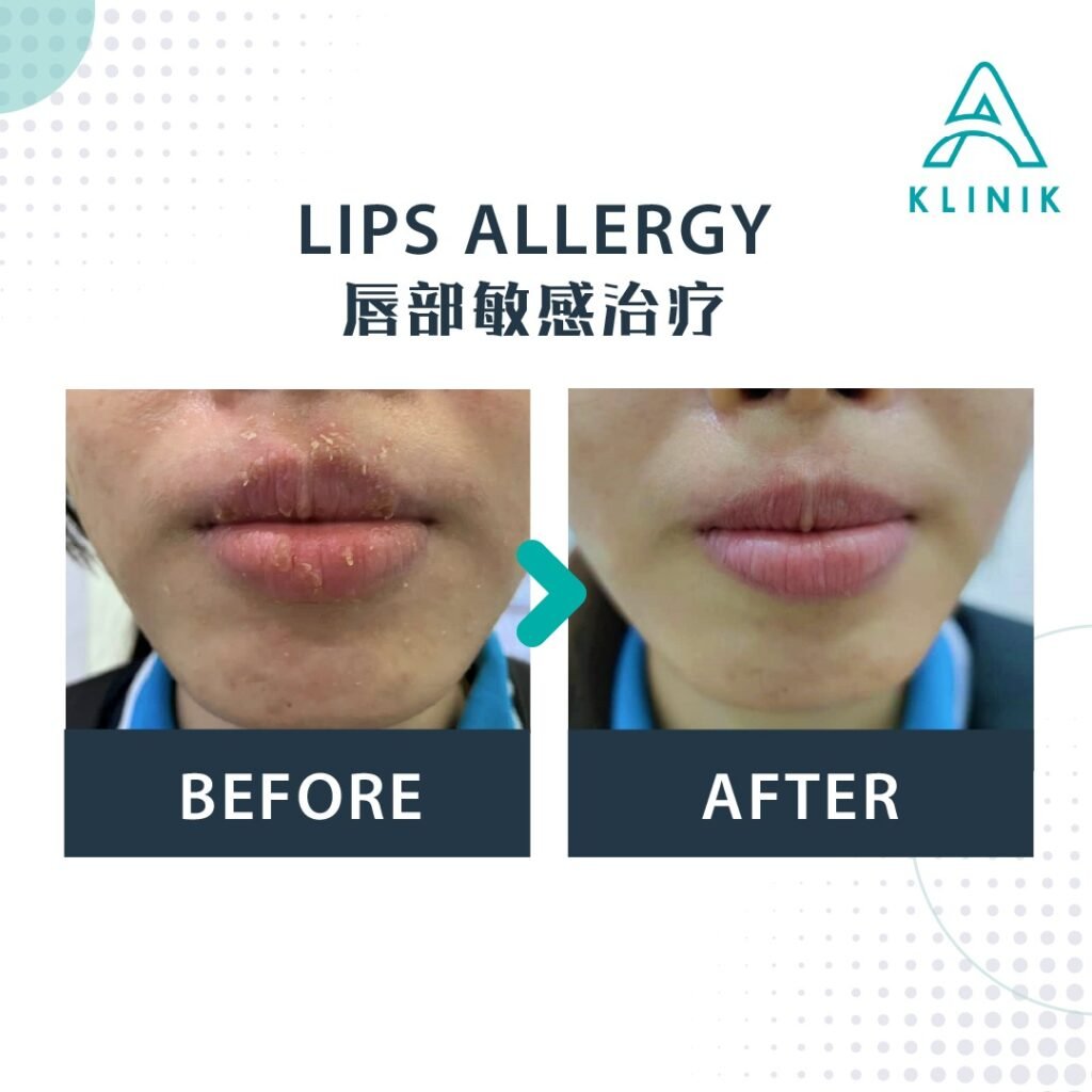 Before and after lips allergy treatment at A Klinik Puchong – visible improvement