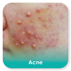 acne