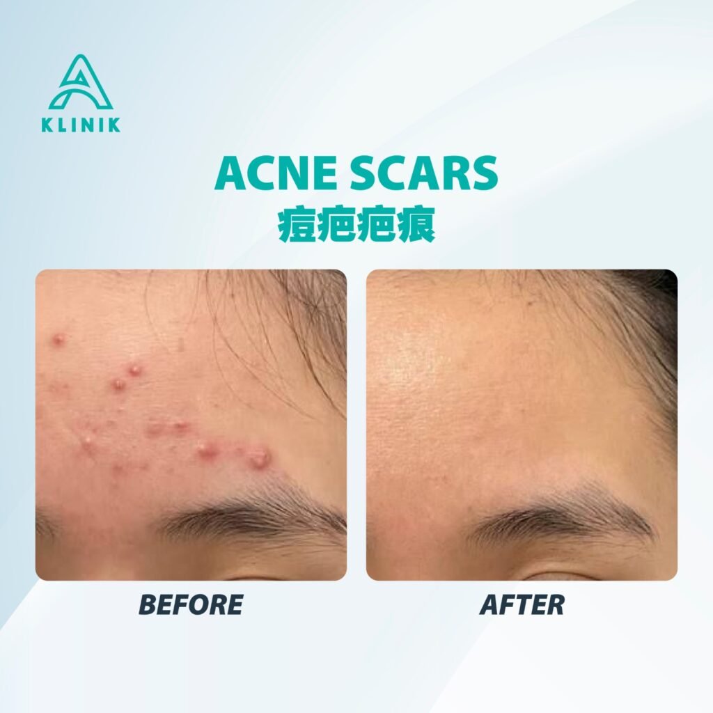 Before and after acne scar treatment at A Klinik Puchong – visible improvement