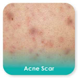 acne scar