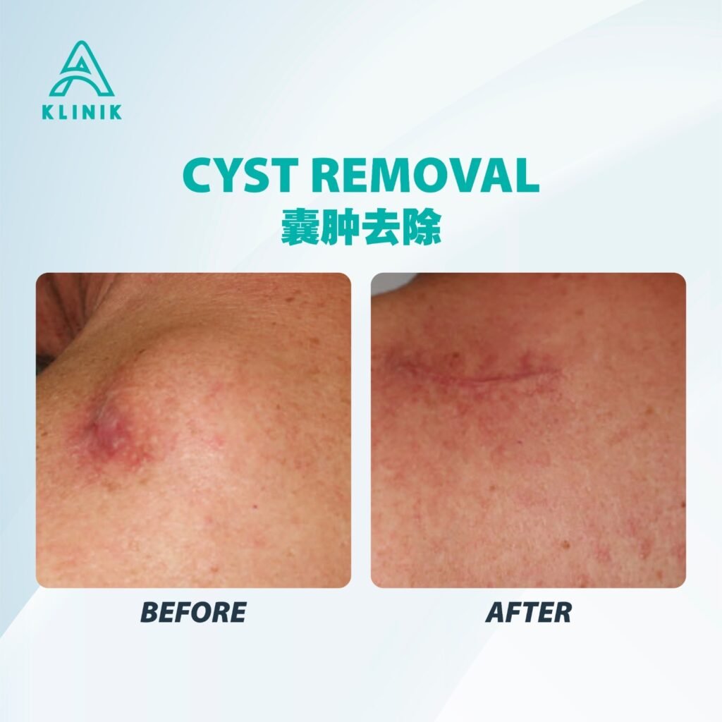 Before and after cyst removal treatment at A Klinik Puchong – visible improvement