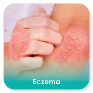 eczema