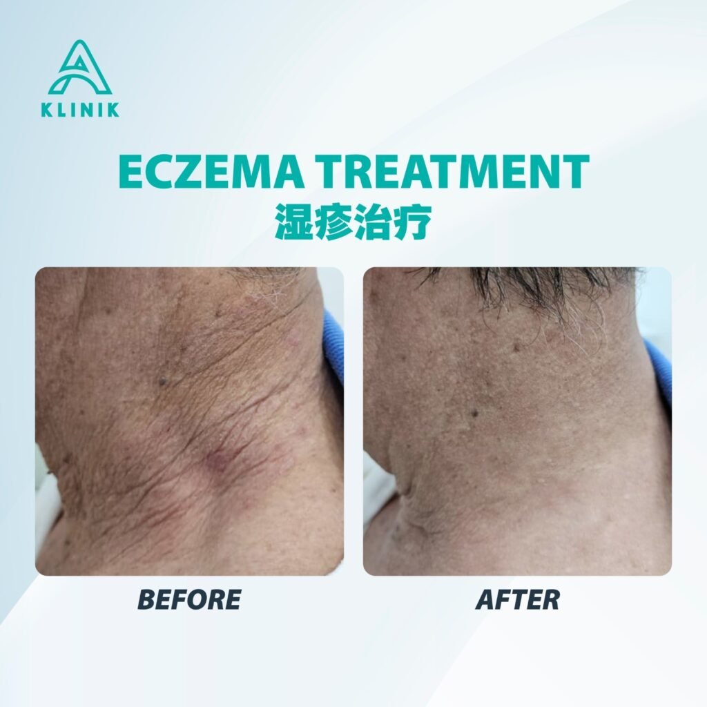 Before and after eczema treatment at A Klinik Puchong – visible improvement