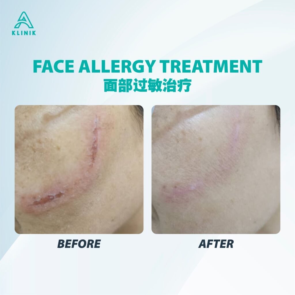 Before and after face allergy treatment at A Klinik Puchong – visible improvement