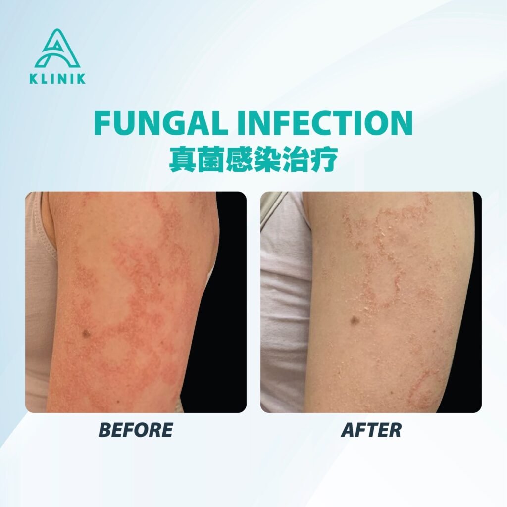 Before and after fungal infection treatment at A Klinik Puchong – visible improvement