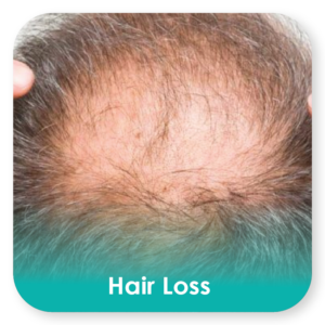 hair loss