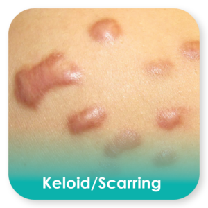 keloid