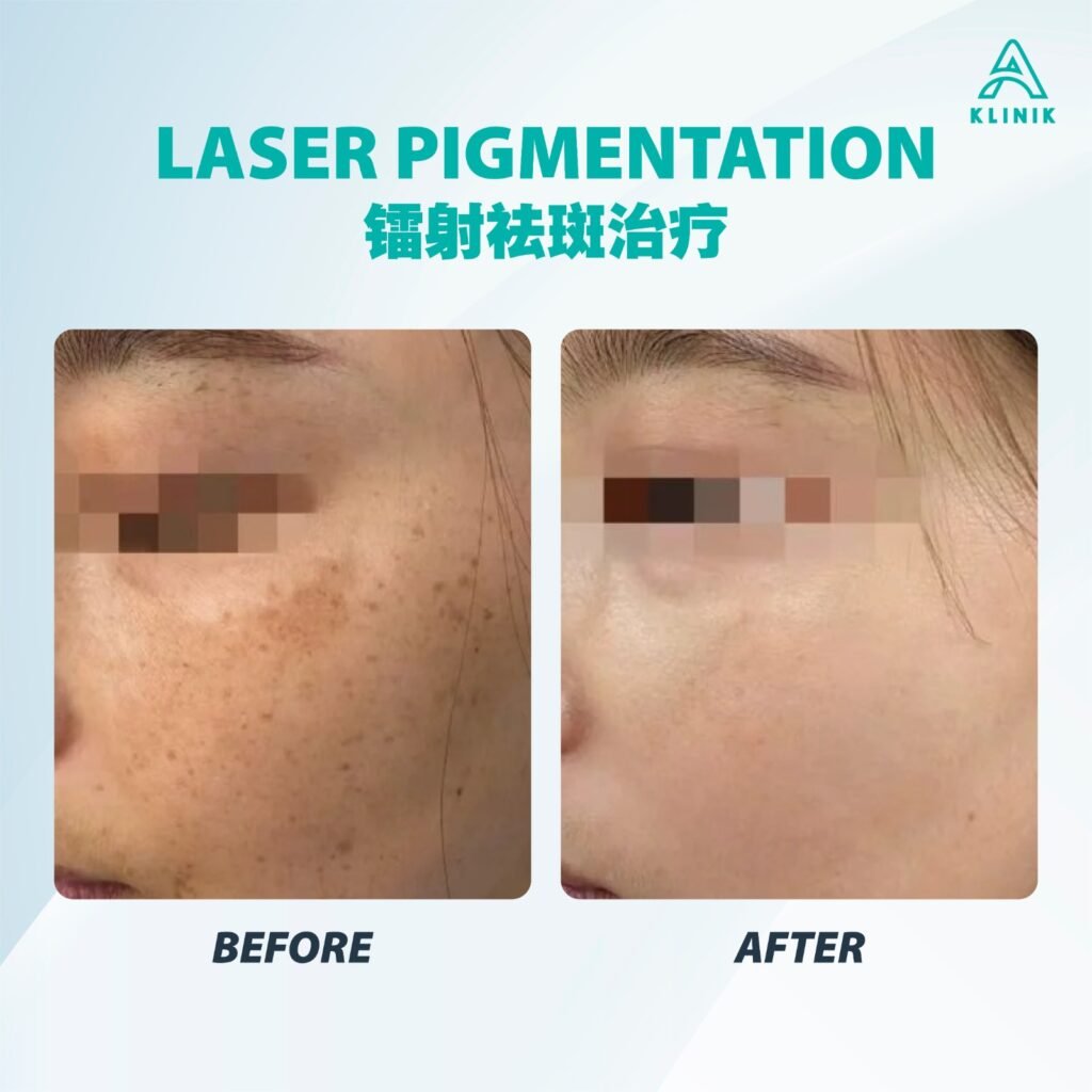 Before and after laser pigmentation treatment at A Klinik Puchong – visible improvement