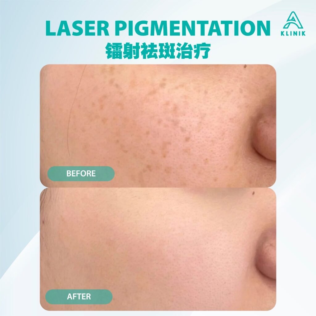 Before and after laser pigmentation treatment at A Klinik Puchong – visible improvement
