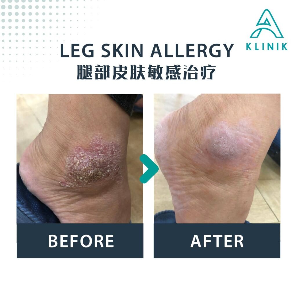Before and after leg skin allergy treatment at A Klinik Puchong – visible improvement