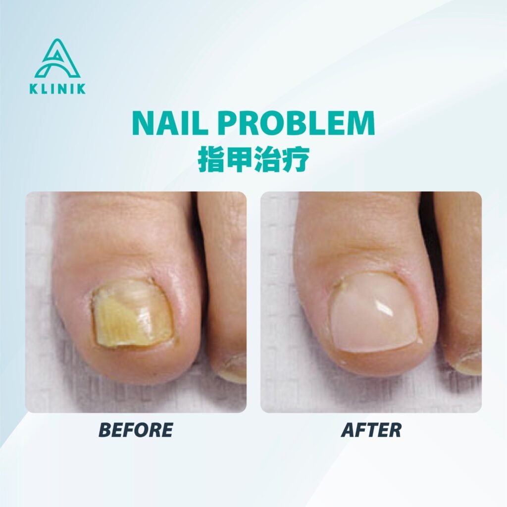 Before and after nail problem treatment at A Klinik Puchong – visible improvement