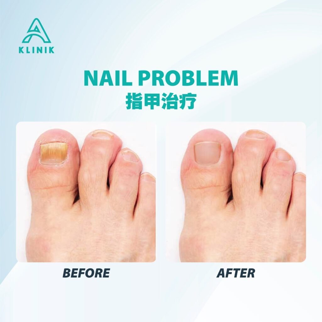 Before and after nail problems treatment at A Klinik Puchong – visible improvement