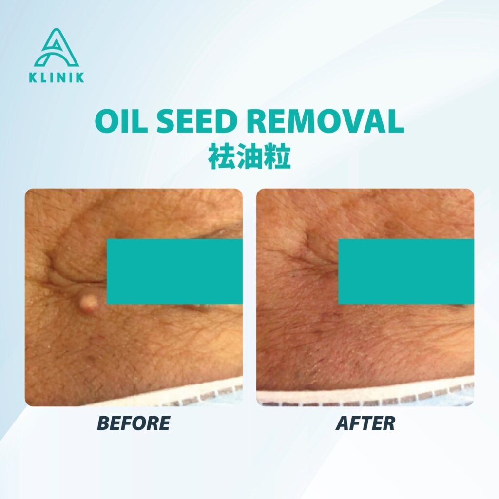 Before and after oil seed treatment at A Klinik Puchong – visible improvement