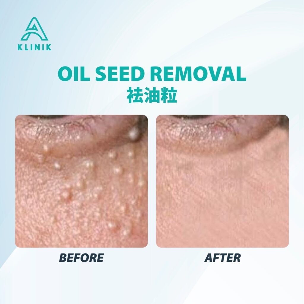 Before and after oil seed removal treatment at A Klinik Puchong – visible improvement