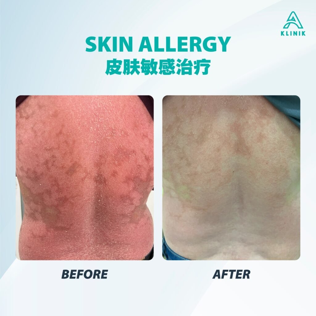 Before and after skin allergy treatment at A Klinik Puchong – visible improvement