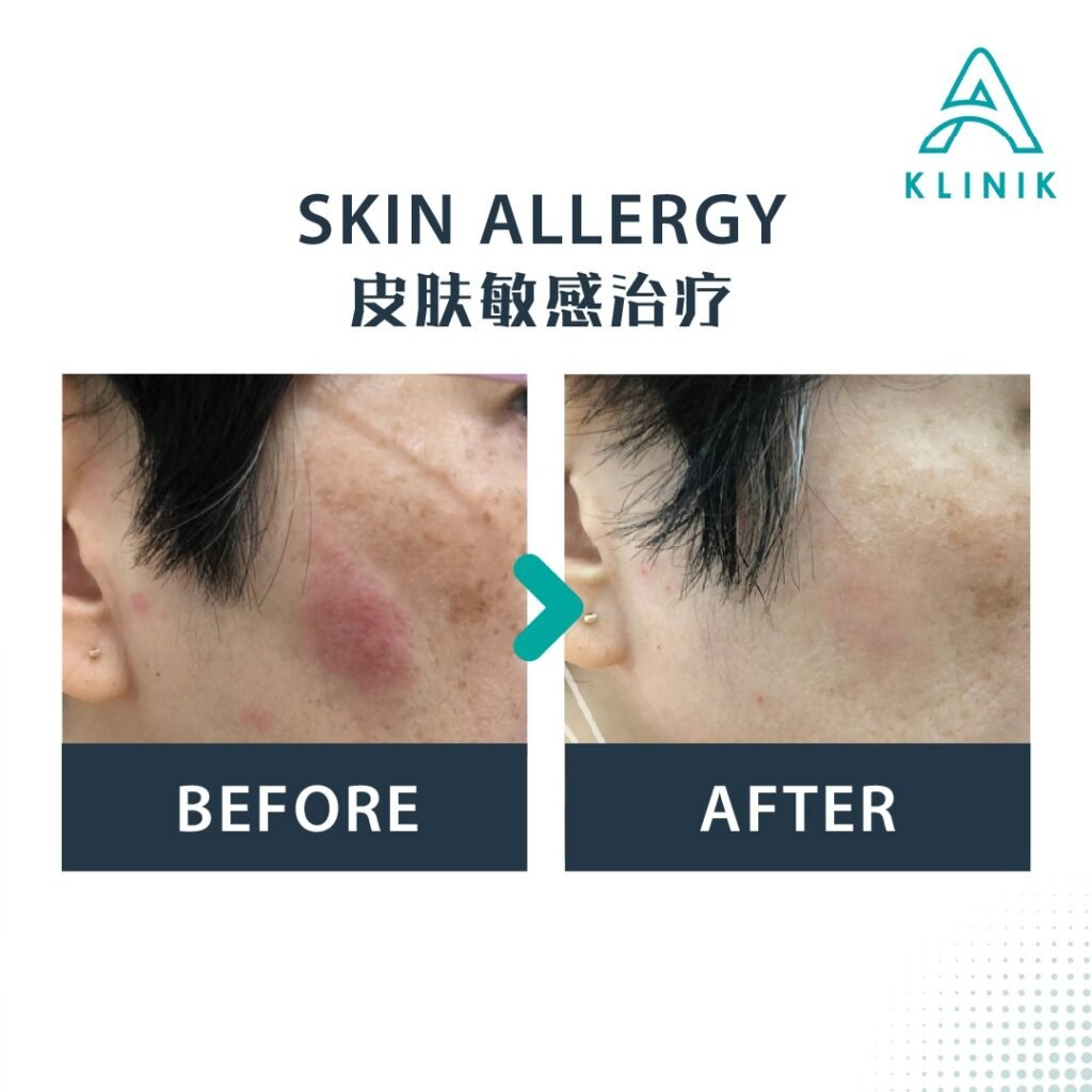 Before and after skin allergy treatment at A Klinik Puchong – visible improvement