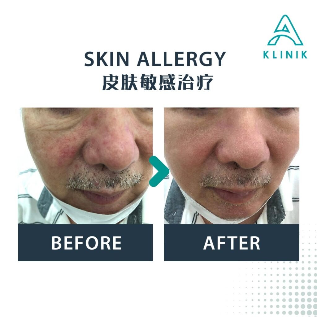 Before and after skin allergy treatment at A Klinik Puchong – visible improvement
