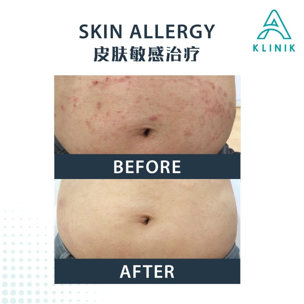 Before and after skin allergy treatment at A Klinik Puchong – visible improvement