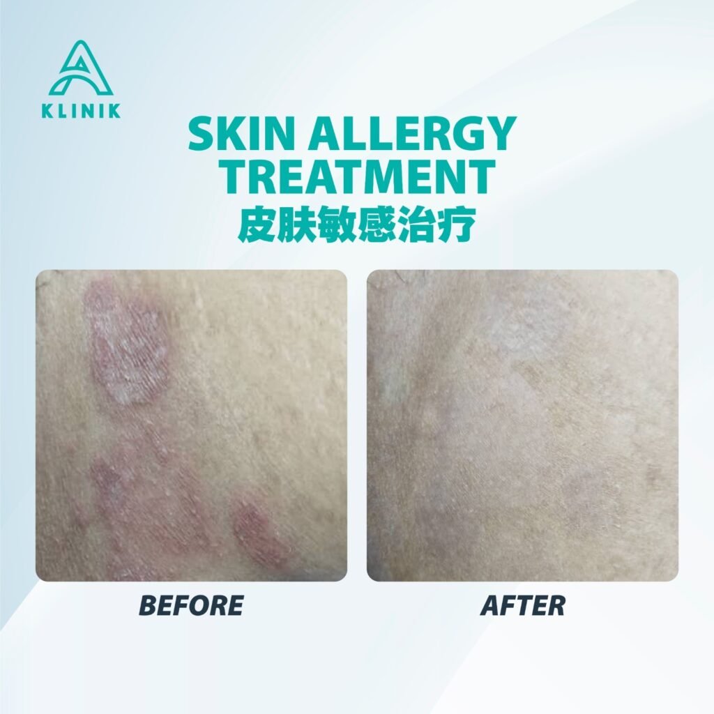Before and after skin allergy treatment at A Klinik Puchong – visible improvement