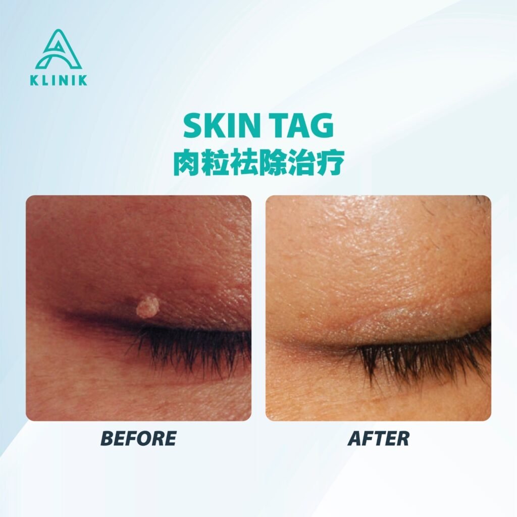 Before and after skin tag treatment at A Klinik Puchong – visible improvement