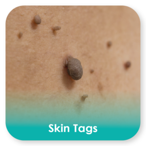 skin tags