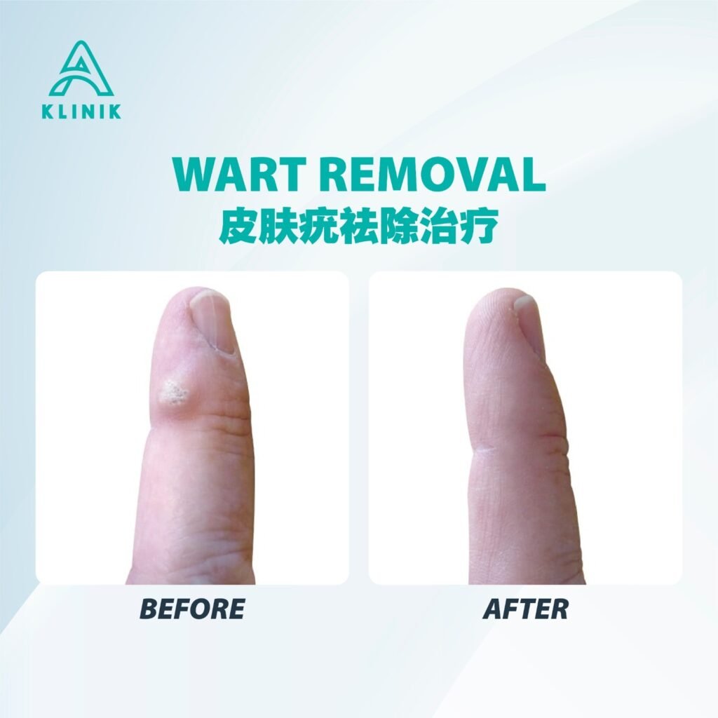 Before and after wart removal treatment at A Klinik Puchong – visible improvement