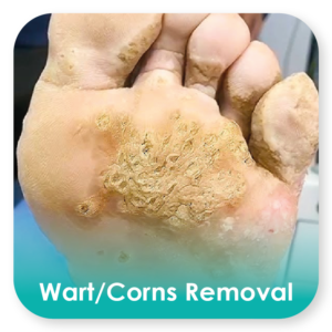 wart removal