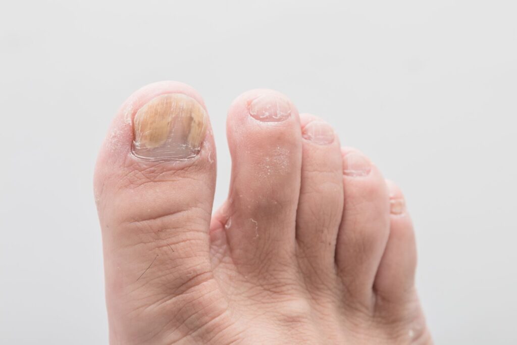 Nail Problem