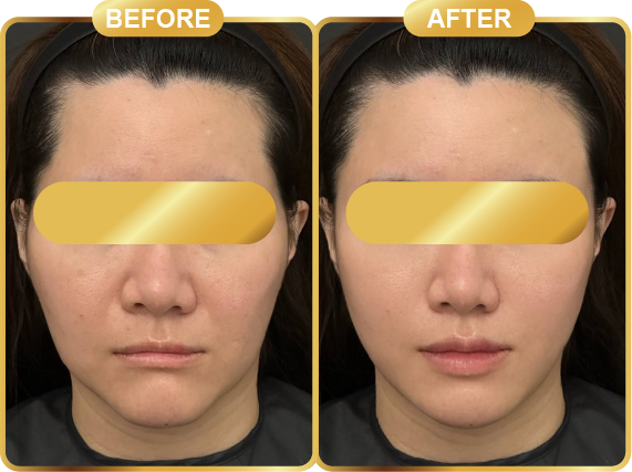before & after-51