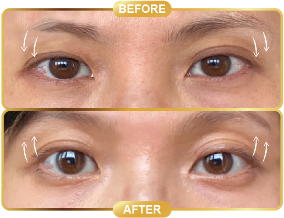 before & after-53