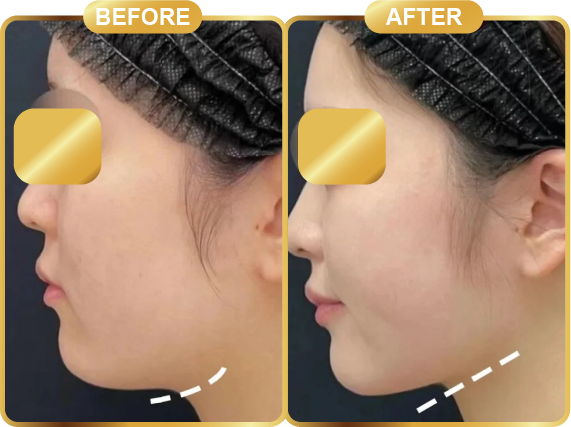before & after-56