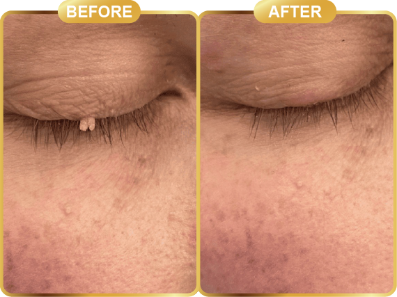 before & after-70